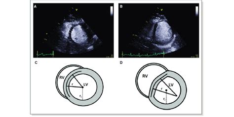 d shaped septal flattening.